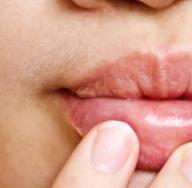 Where did the sore on the lips come from?